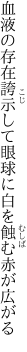 血液の存在誇示して眼球に 白を蝕む赤が広がる